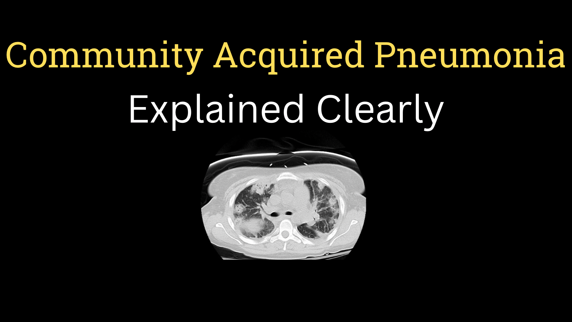 <h1><strong>Community-Acquired Pneumonia</strong></h1>