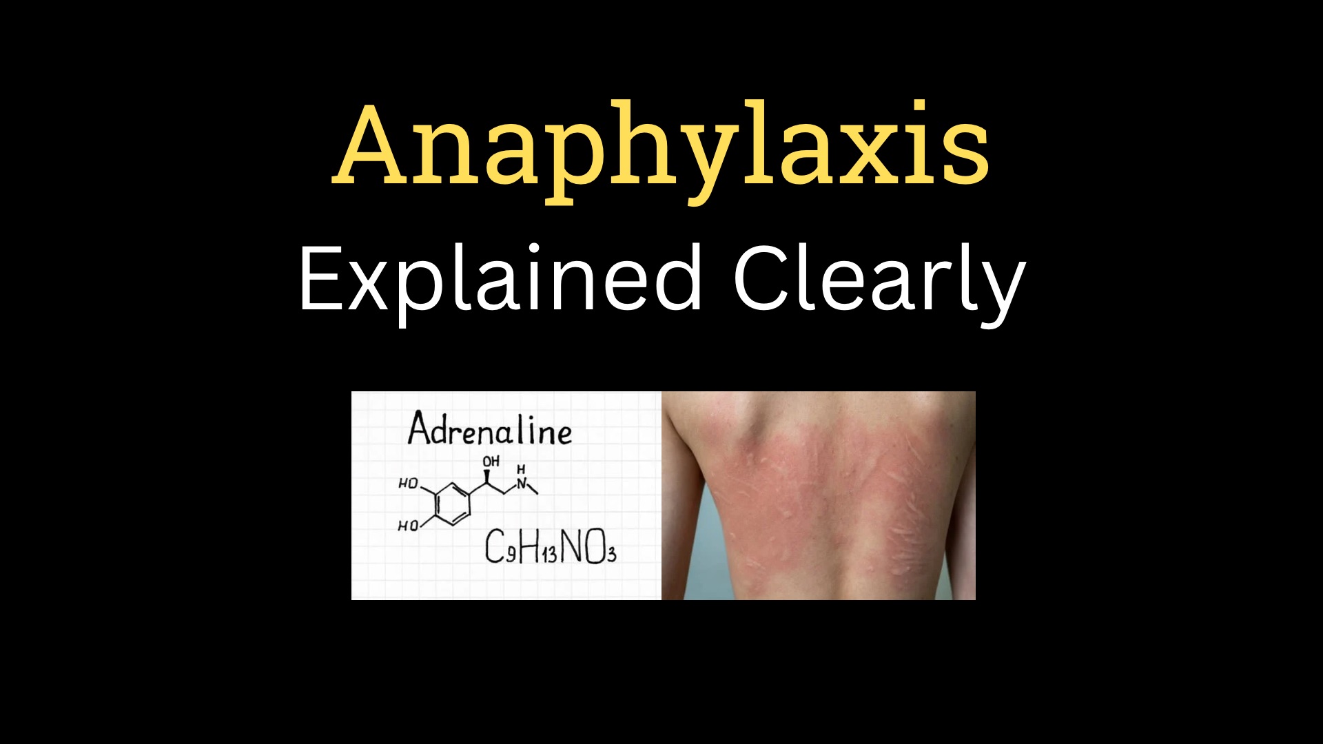 <h1><strong>Anaphylaxis and Angioedema</strong></h1>